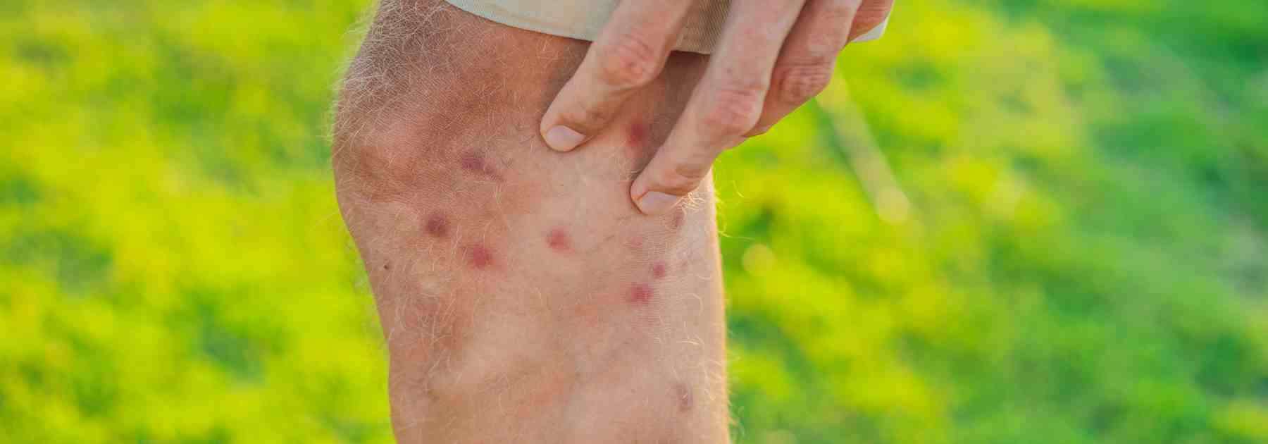 Treat infected insect bites in Hampshire through NHS Pharmacy First. 