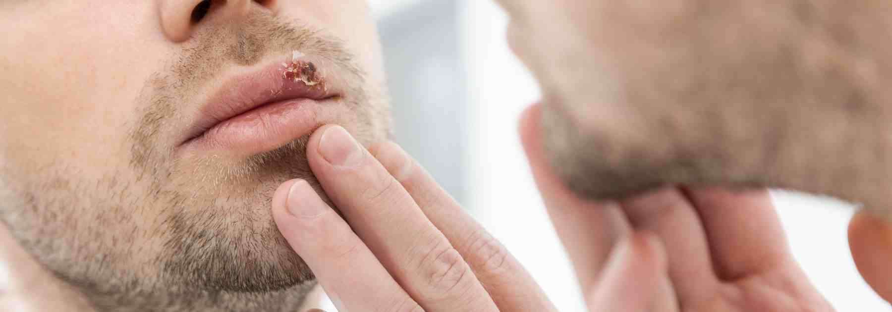 Do I have impetigo or a cold sore?