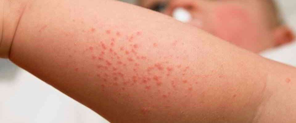 Understand the difference between impetigo and cold sores
