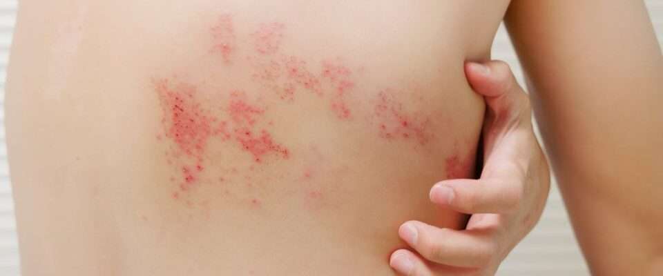 Shingles vaccine consultation and administration at pharmacy