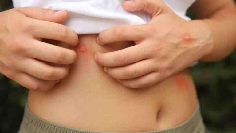Infected insect bite symptoms assessed by pharmacy healthcare team