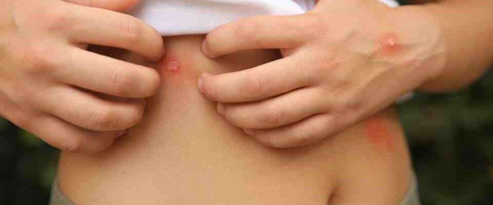 Infected insect bite symptoms assessed by pharmacy healthcare team
